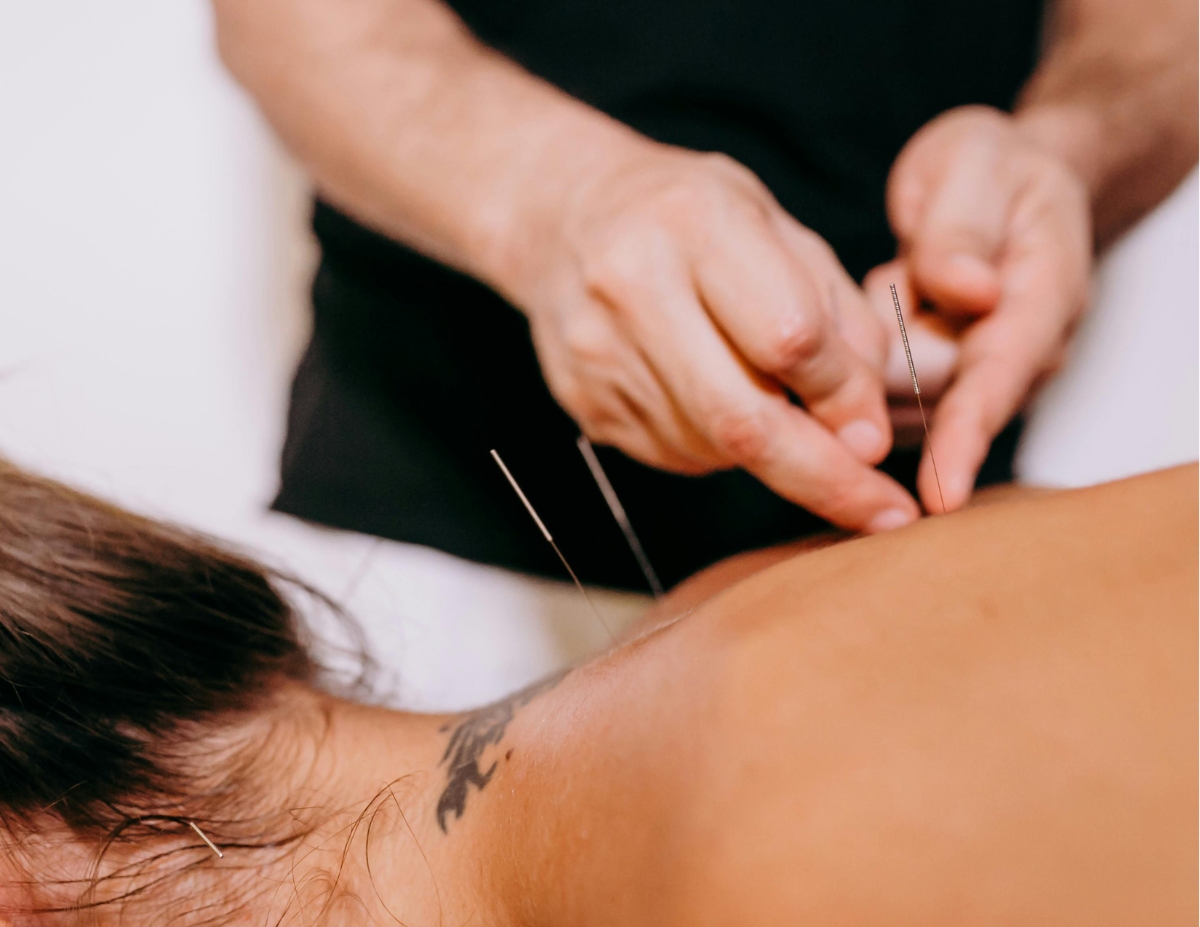 Dry Needling in  Sugar Land, TX 